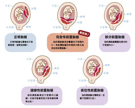 前置胎盤剝離